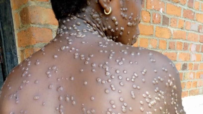 Namibia Confirms First Mpox Case, Declares National Outbreak