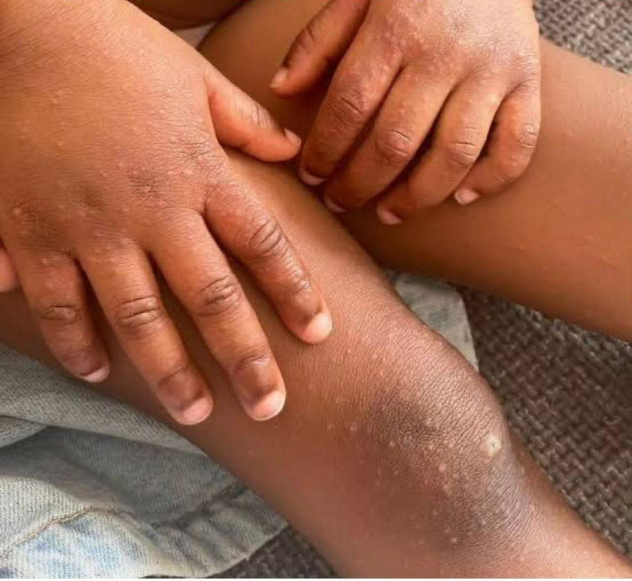 Harare Records Nearly 600 HFMD Cases as Outbreak Spreads Citywide