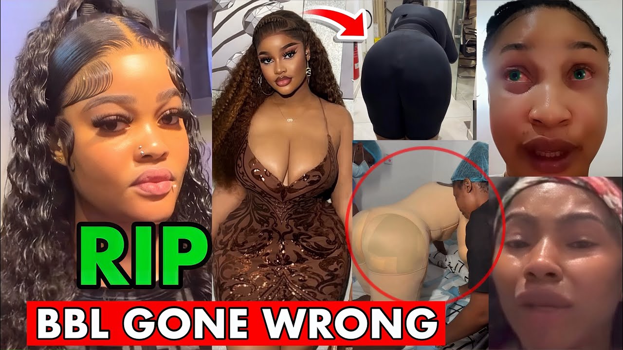 Nigerian Woman Dies After BBL Surgery, Sparking Safety Concerns